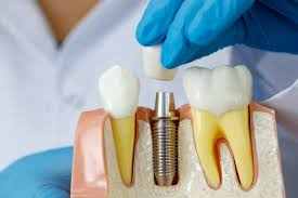 Five Advanced Dental Implant Solutions Available Through Trusted Dental Clinics Across Rolla