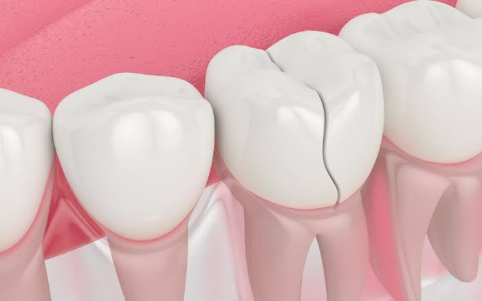 Restorative Dentistry Solutions for a Tooth Damaged in Falls Church
