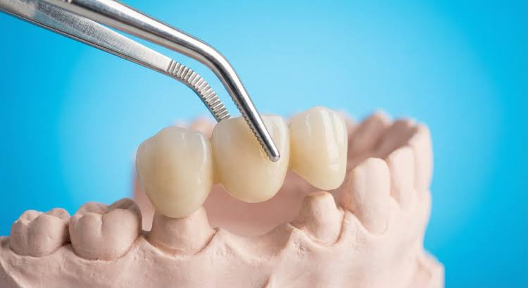 Situations Where a Dental Crown May Be the Better Option for Patients in North York