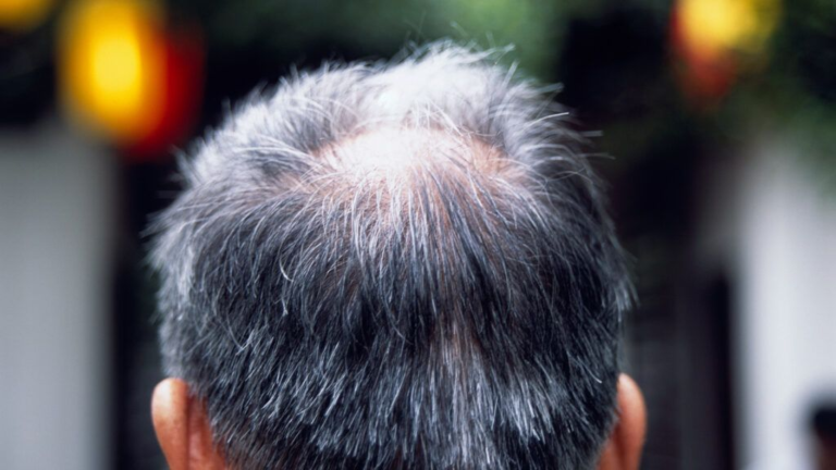 Hair Thinning: A Simple Guide to Causes, Daily Care, and Medical Checkups